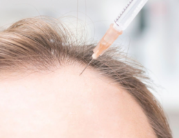 PRP treatment for hair loss