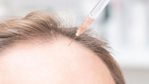 PRP treatment for hair loss