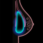 Breast implant in female silhouette, subpectoral placement. 3d realistic poster, x ray scanning. Bust enhancement operation, woman chest after plastic surgery. Isolated vector illustration for clinic.