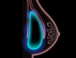 Breast implant in female silhouette, subpectoral placement. 3d realistic poster, x ray scanning. Bust enhancement operation, woman chest after plastic surgery. Isolated vector illustration for clinic.